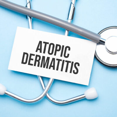 Atopic dermatitis – Symptoms and management tips