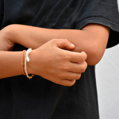 Prurigo nodularis – Causes, symptoms, and management