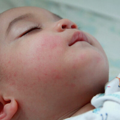 Eczema in babies, kids, and teens – Signs and management